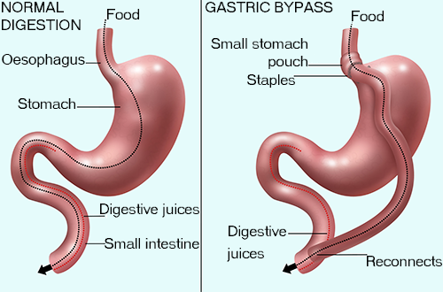  Gastric Bypass Surgery