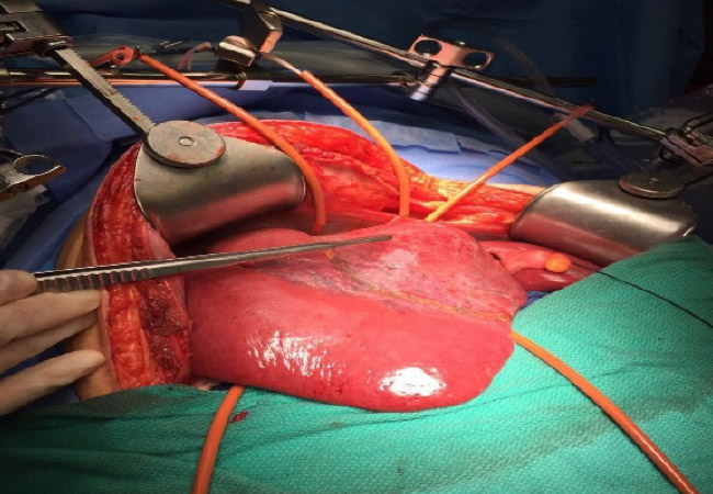 Hepatectomy Liver Resection