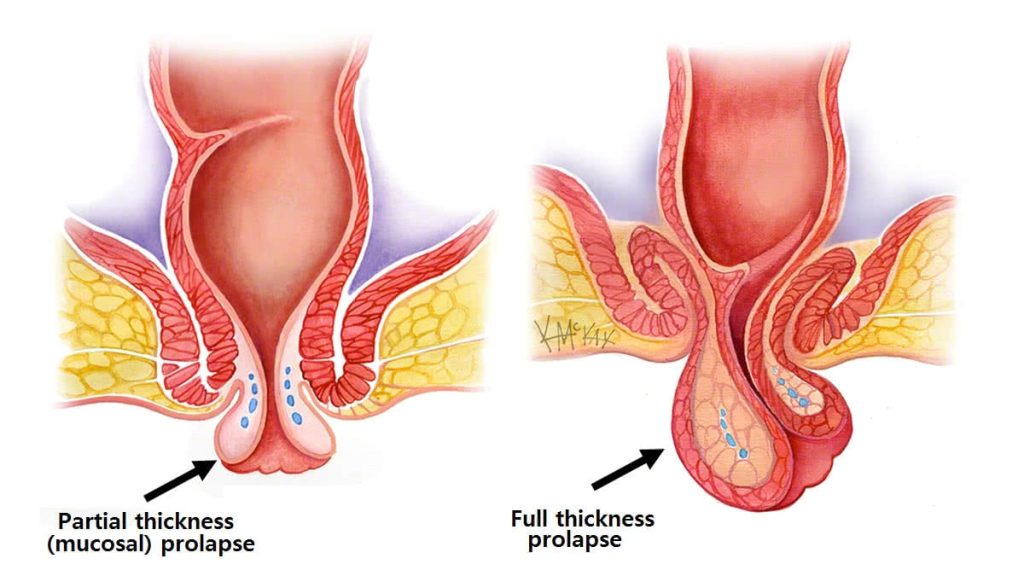 rectal prolapse e