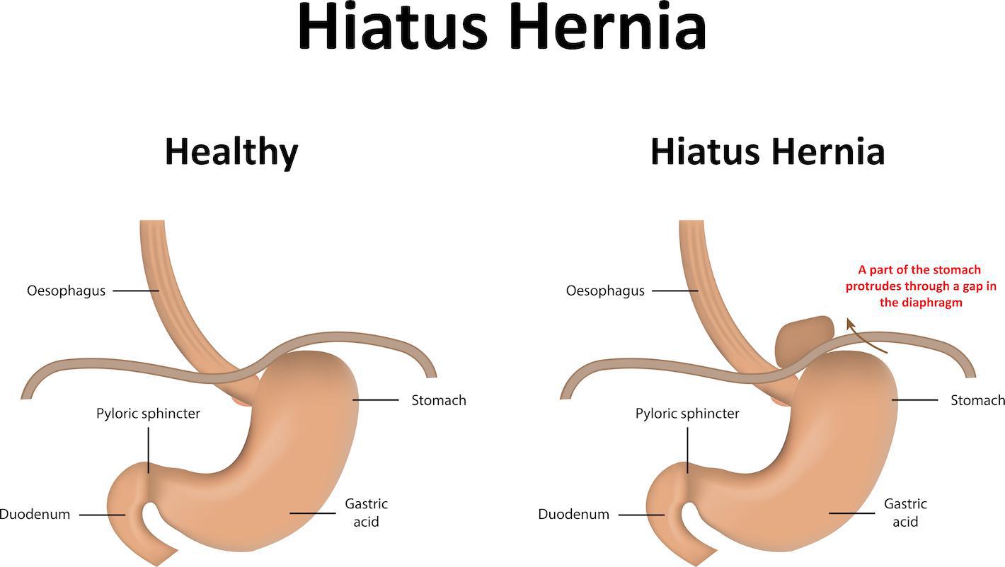 can a hiatal hernia put pressure on descending aorta 2