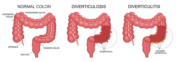 diverticulitis