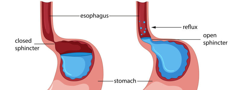 gastroesophageal blog