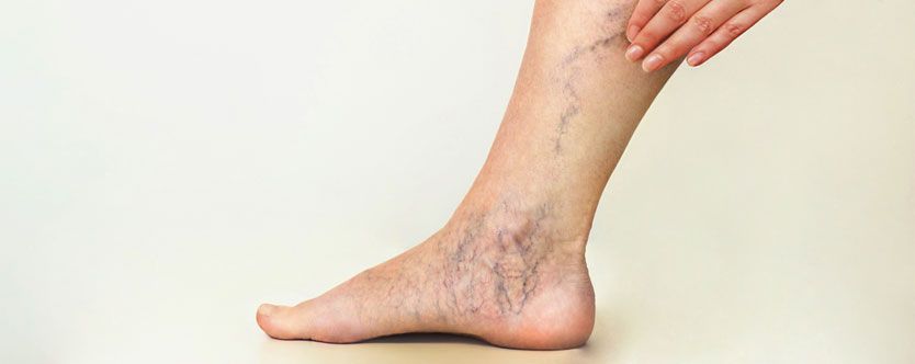 varicose veins banner scalia gallery fullwidth