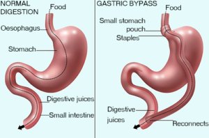 Gastric Bypass surgery