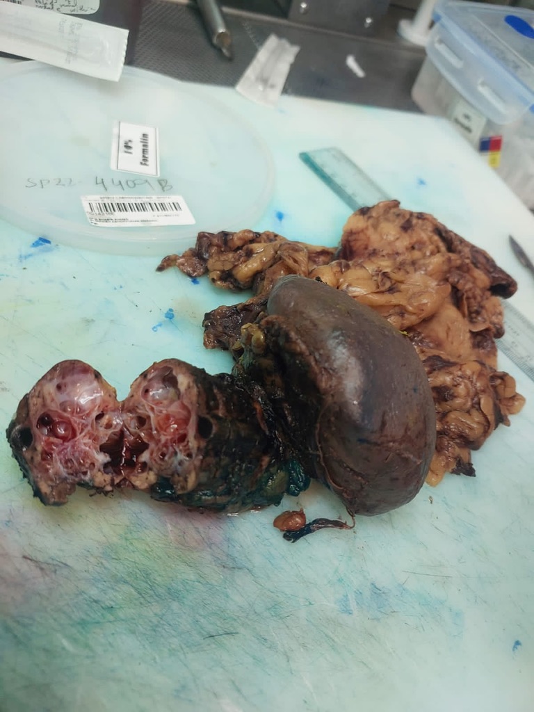 Pancreas Surgery