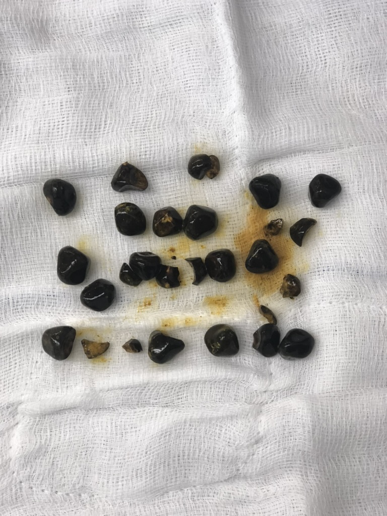 Gallstones