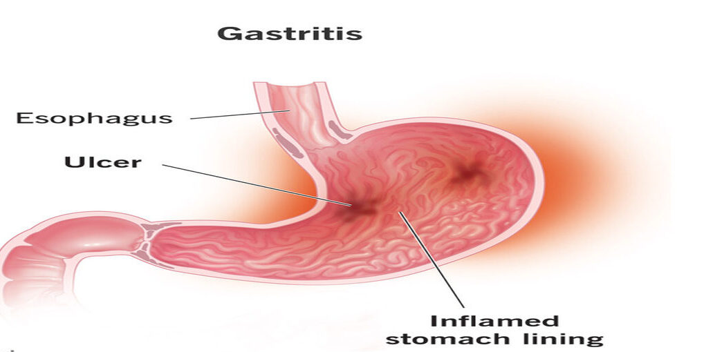 10349 gastritis 2 e1715672451407