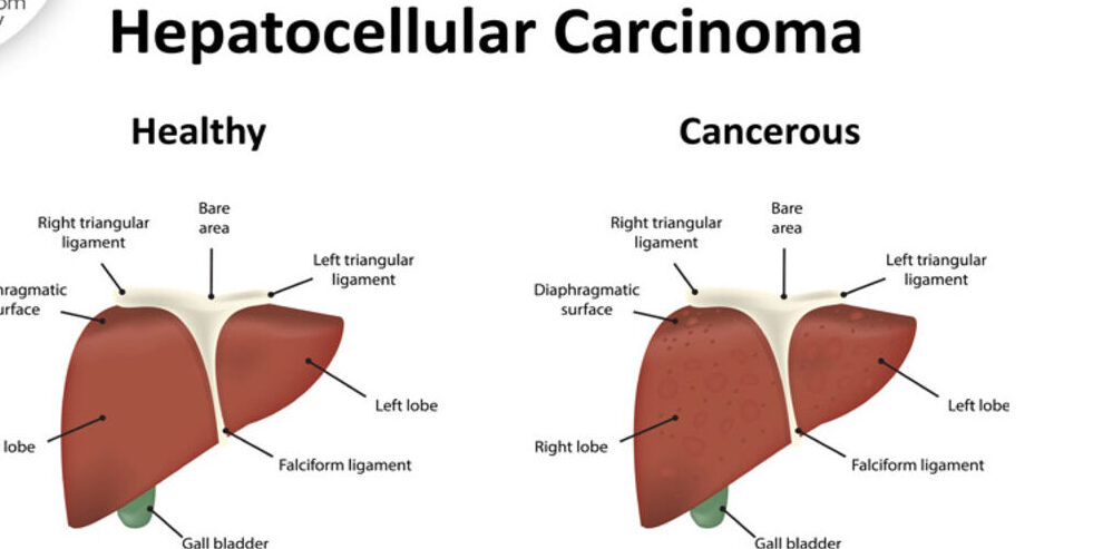 1669620461 Hepatocellular 898x450 1 e1715685014499