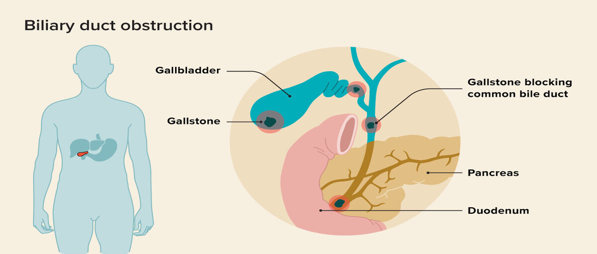 1827269 Biliary Duct Obstruction 1 e1715680803432