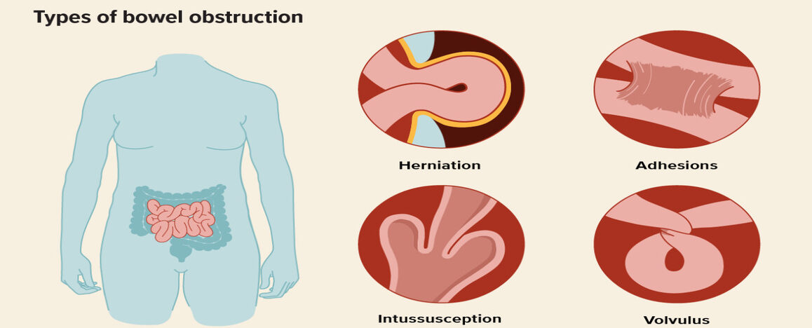 1989830 Types of Bowel Obstruction 1296x876 3 e1715690250933