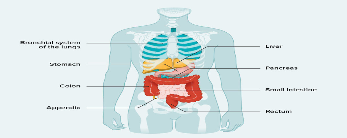 2452553 All About Carcinoid Tumors 1296x1147body 1 1 e1715691319195