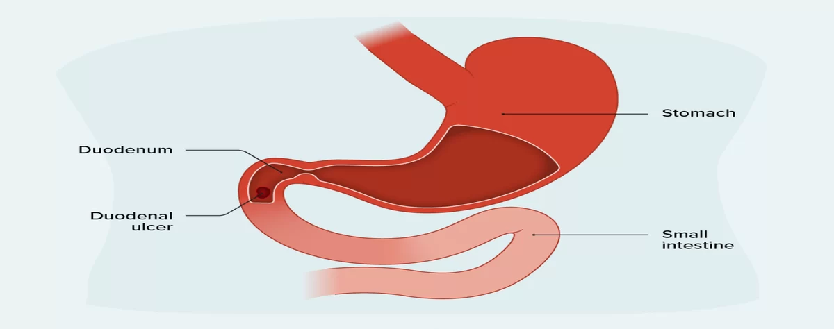 3027466 What is a Duodenal Ulcer 1296x1085 body 1 e1715673017478