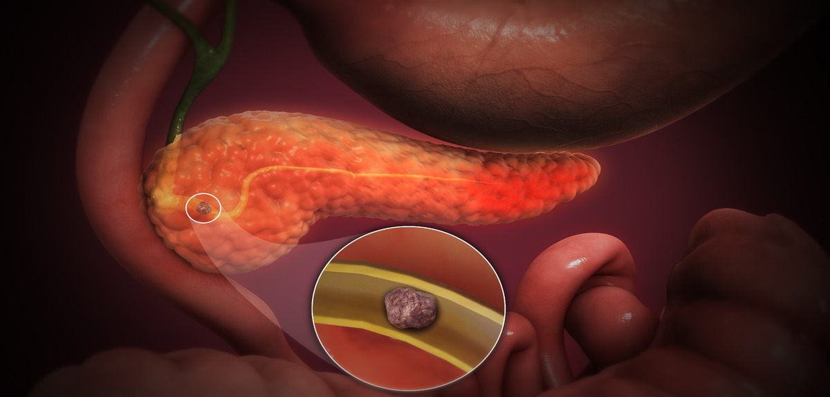 3D Medical Animation Acute Pancreatitis 1