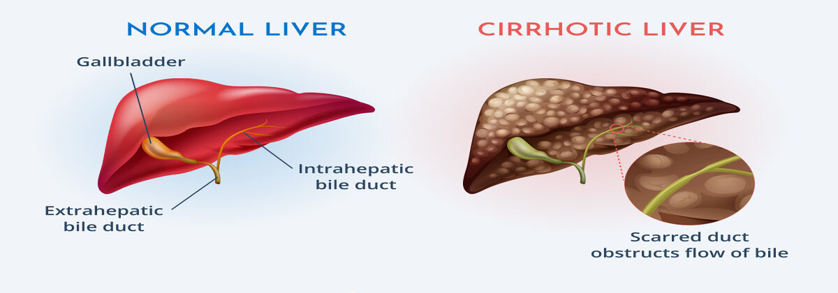 65565ec8da3de75ac6f63e96 Primary Biliary Cholangitis 1 1 e1715682174674