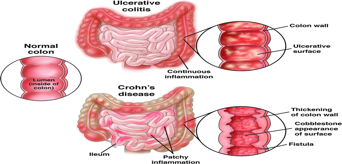 CGH Patient Ed IBD2.0 2019 1