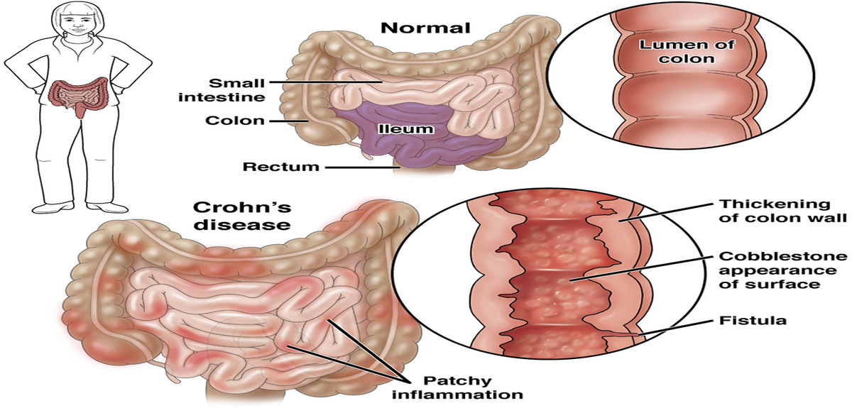 CGH PatientEd Crohns 2020 1 1