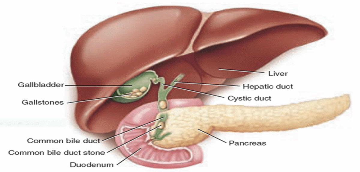 Choledocholithiasis 1