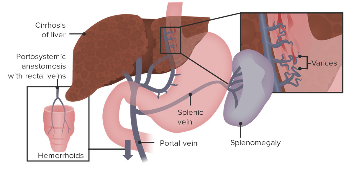 Esophageal varices splenomegaly and rectal varices in portal hypertension 1