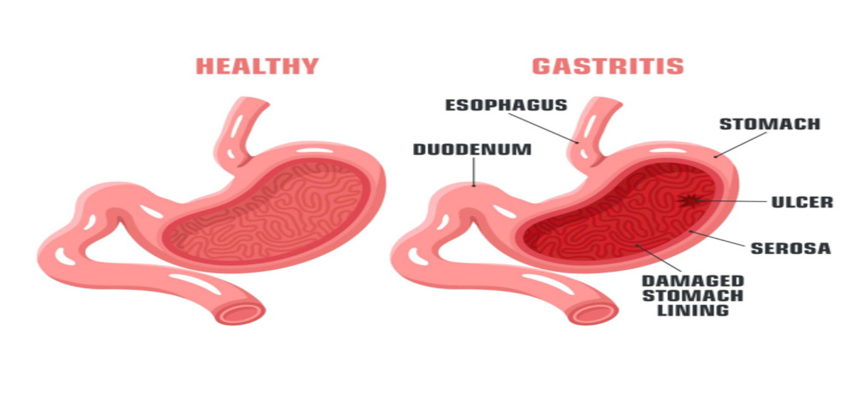 Gastritis diagram 1 1