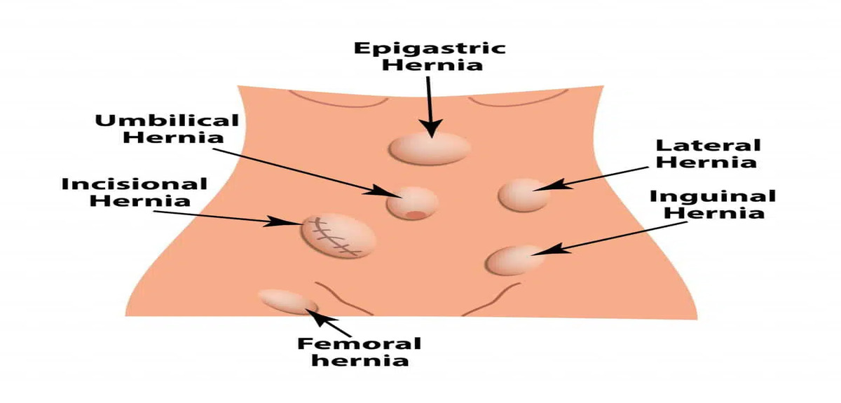 Hernia Types.jpg 1