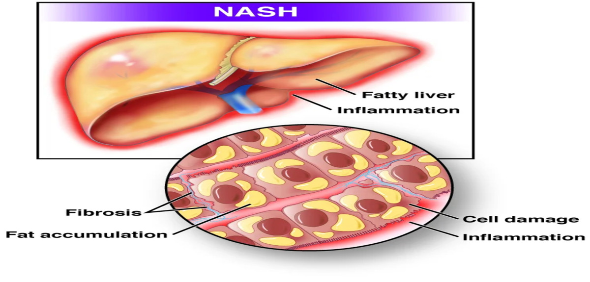 NASH 1