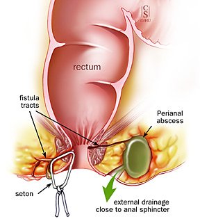 anal fistula