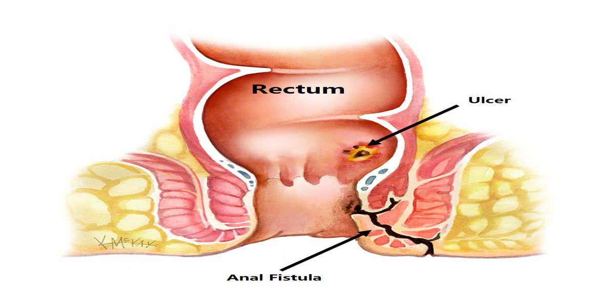 anal fistula e 1