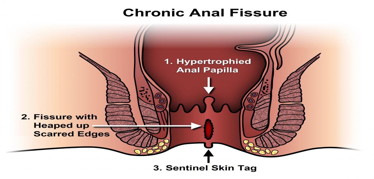 anal fissure 1