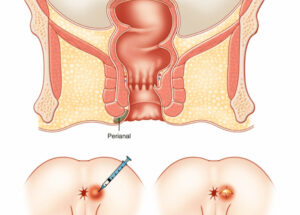 Anorectal Surgery