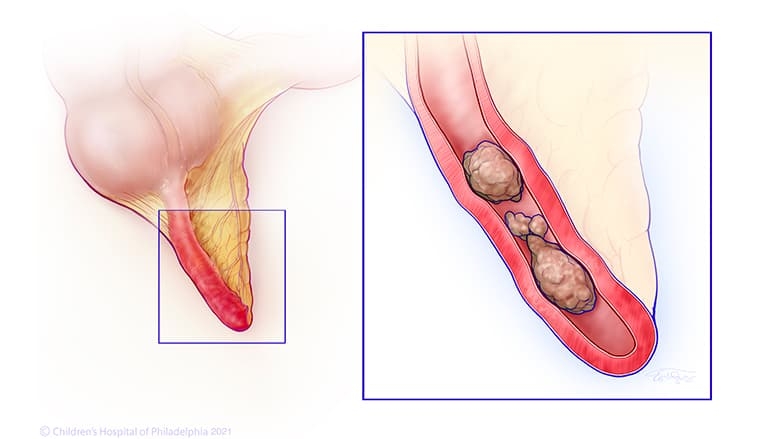 appendicitis