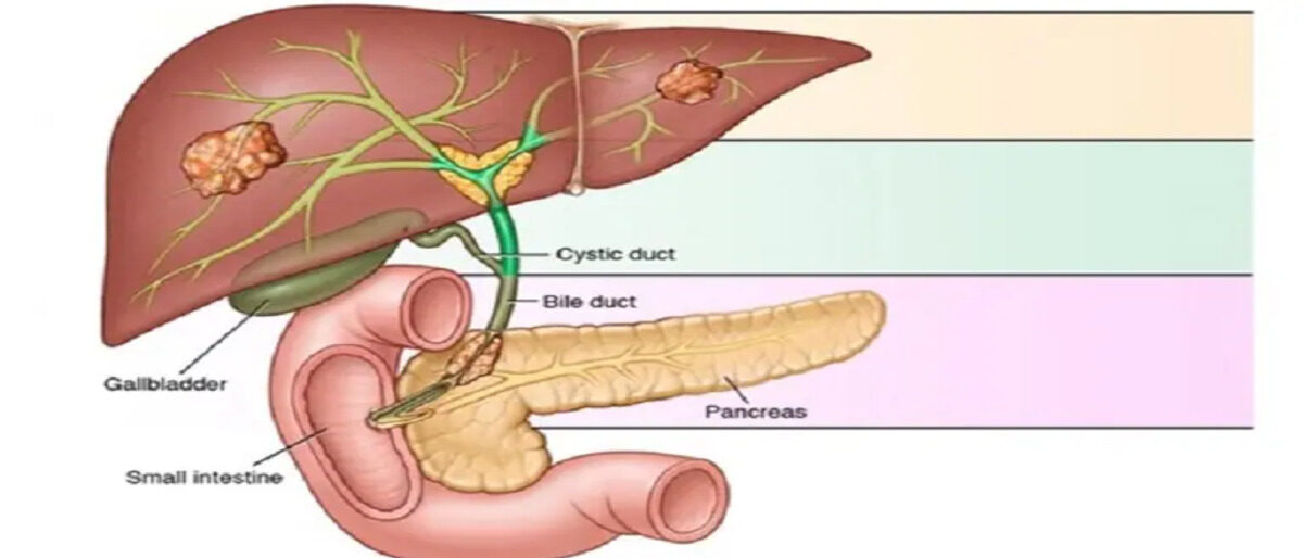 bile duct cancer 767x535 1 e1715681471972