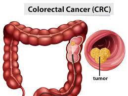 Colorectal Surgery