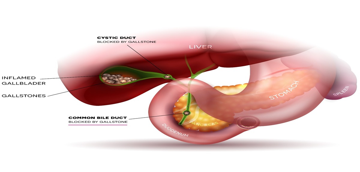 common bile duct stones 001 2