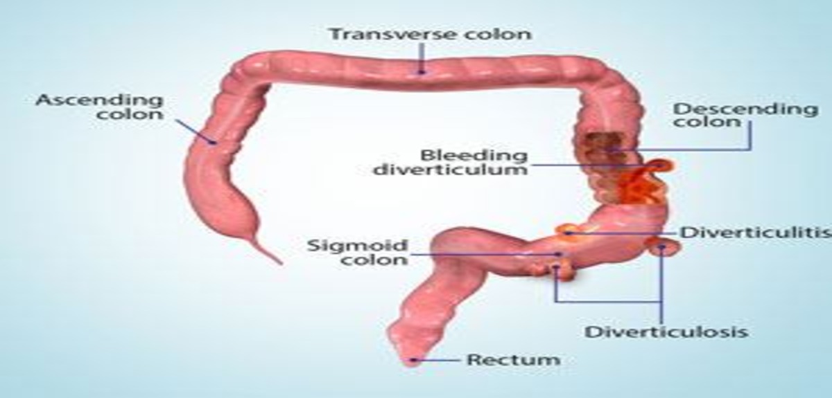 diverticular disease 1