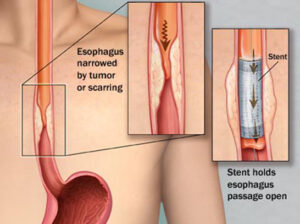 Esophageal Surgery