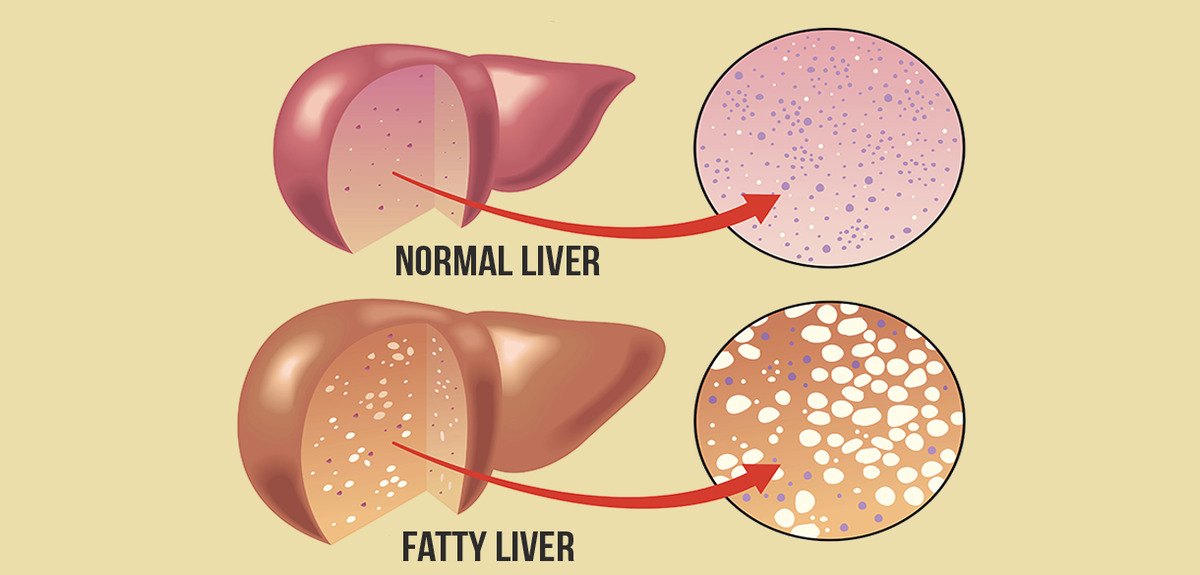 fatty liver can damage other organs 1