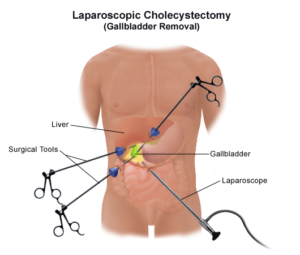 Gall Bladder Surgery