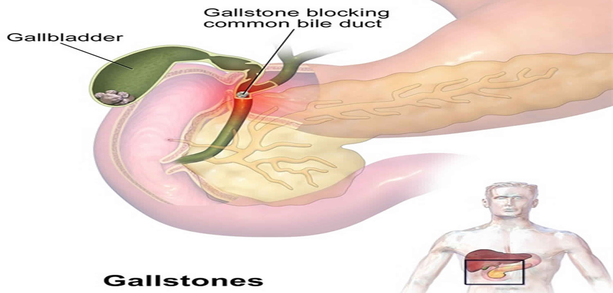 gallstones 1