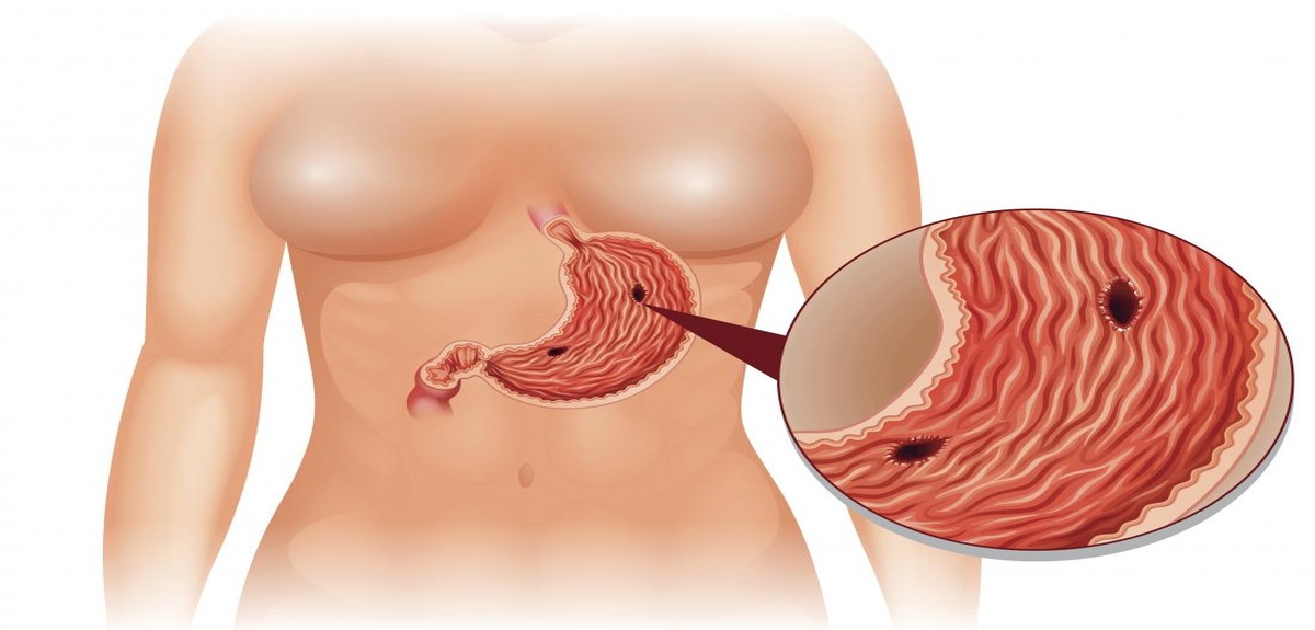 gastrointestinal perforation 1