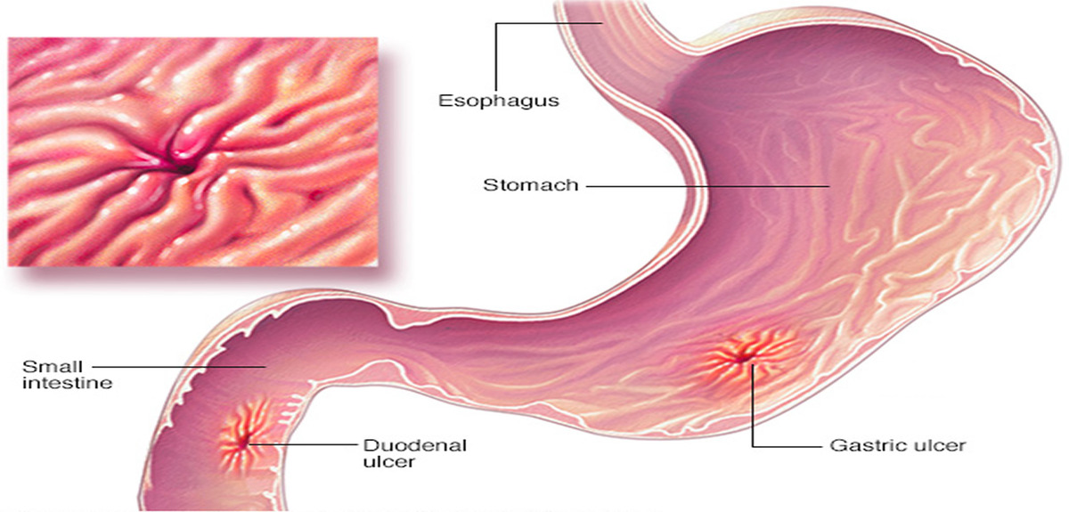 helicobacter pylori infection 1