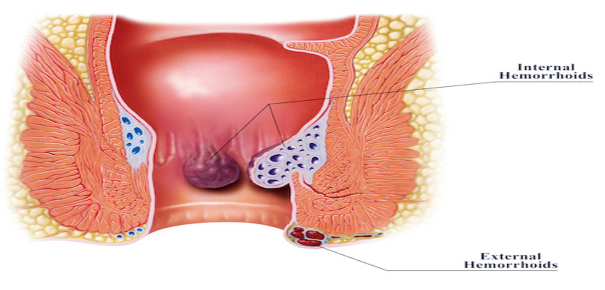 hemorrhoid diagram 500 1