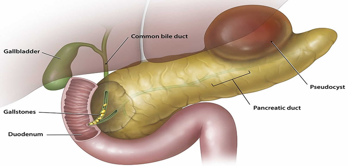 pancreatic pseudocyst 1