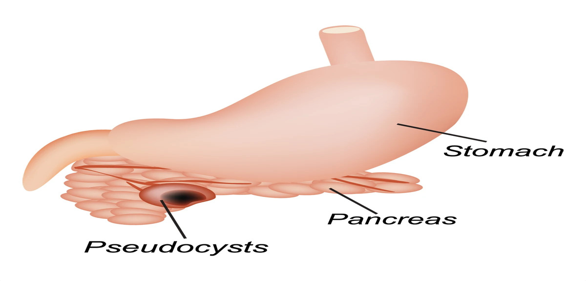 pancreatic pseudocyst 1