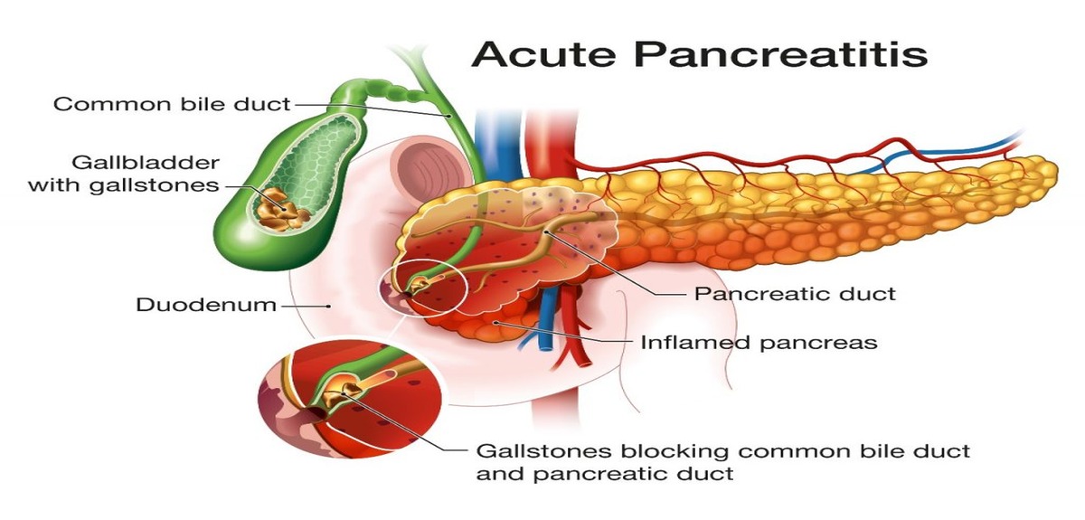 pancreatitis acute 001 1024x757 1 1