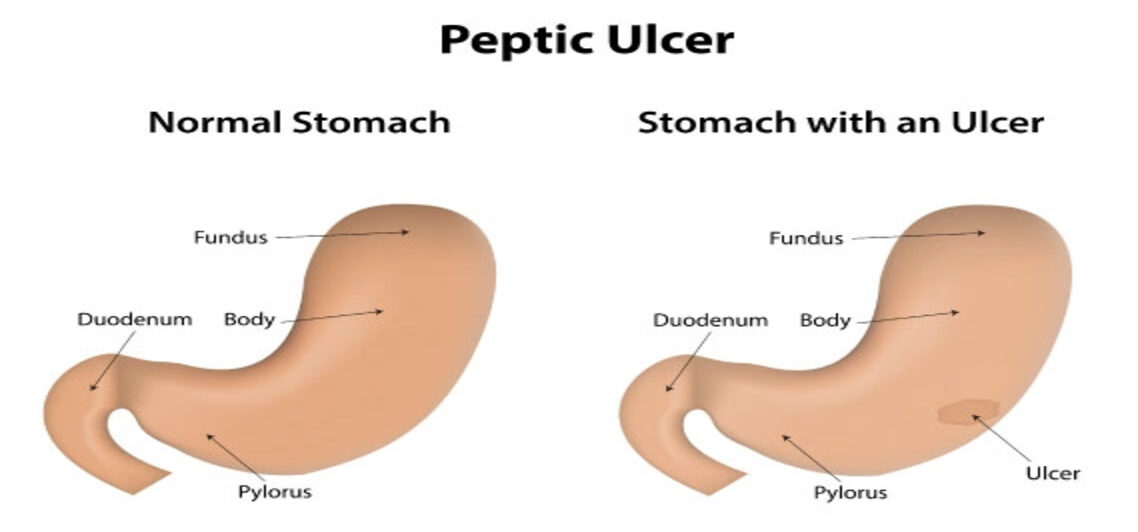 peptic ulcer 1 e1715673249782