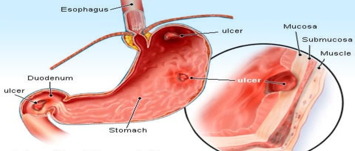 peptic ulcer 1 e1715691737816