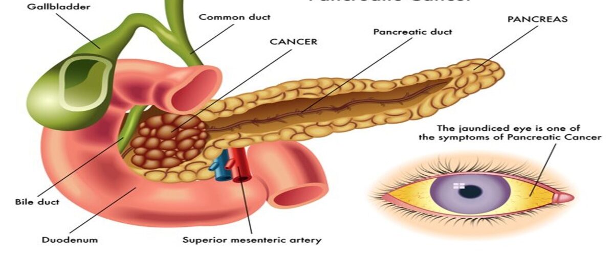 symptoms of pancreatic cancer 1 e1715687642132