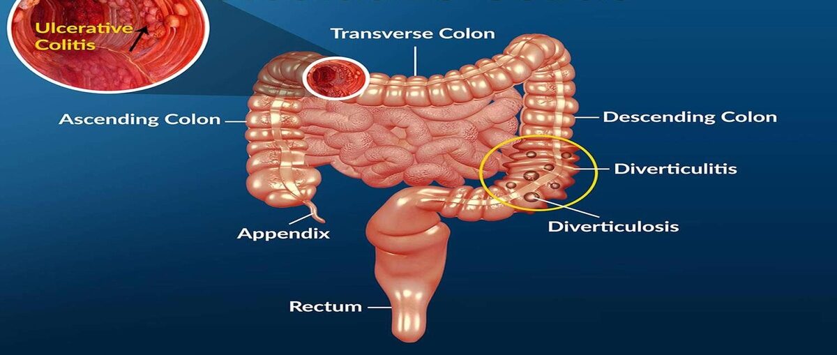 ulcerative collitis 1 e1715692632758