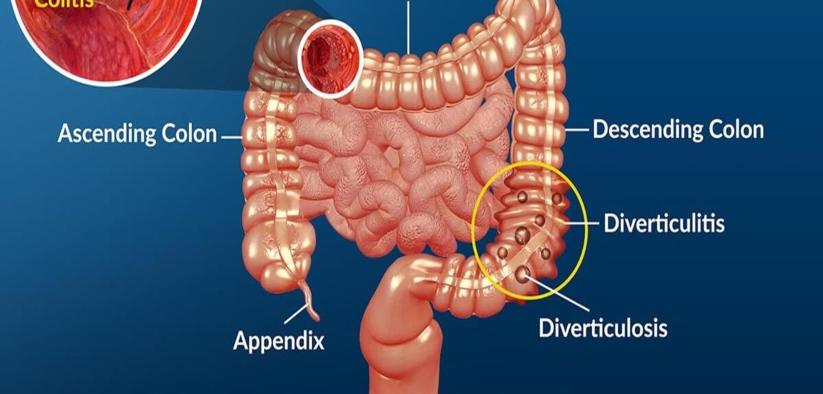 ulcerative collitis 1200x480 1