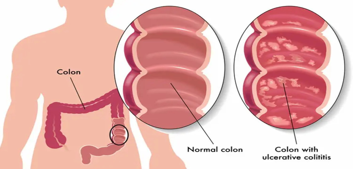 ulcerative colitis 750 1